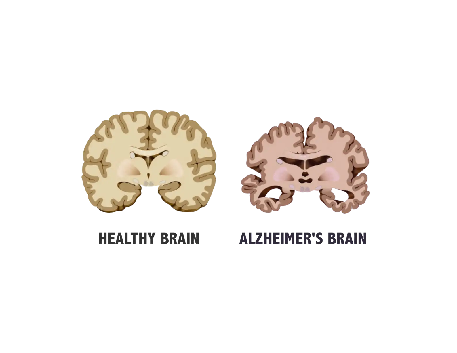 gallery position 1 showing cross sections comparing healthy brain and Alzheimer's brain Support Greg Profits Pay for Alzheimer's Treatments